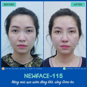 Hình ảnh nâng mũi trước sau Bs Trần Phương - Ca 115