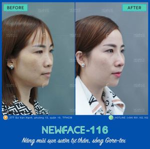 Hình ảnh nâng mũi trước sau Bs Trần Phương - Ca 116