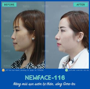 Hình ảnh nâng mũi trước sau Bs Trần Phương - Ca 116