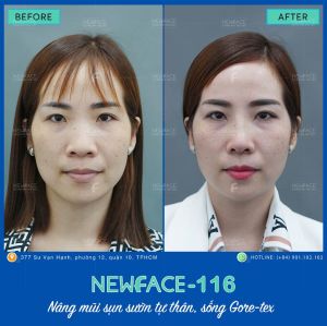 Hình ảnh nâng mũi trước sau Bs Trần Phương - Ca 116