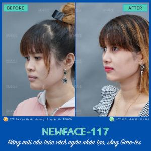 Hình ảnh nâng mũi trước sau Bs Trần Phương - Ca 117