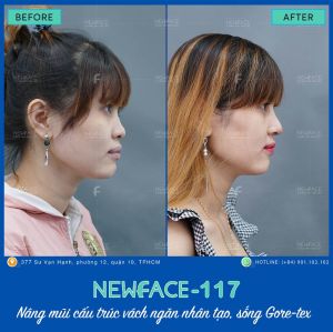 Hình ảnh nâng mũi trước sau Bs Trần Phương - Ca 117