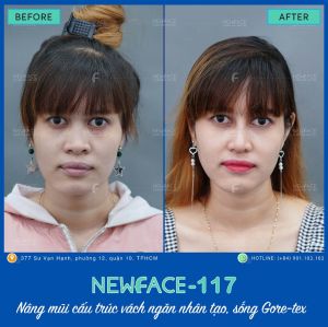 Hình ảnh nâng mũi trước sau Bs Trần Phương - Ca 117