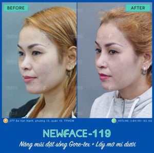 Hình ảnh nâng mũi trước sau Bs Trần Phương - Ca 119