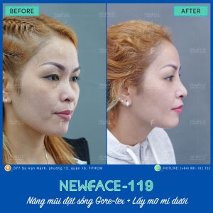 Hình ảnh nâng mũi trước sau Bs Trần Phương - Ca 119