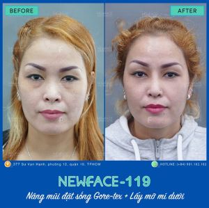 Hình ảnh nâng mũi trước sau Bs Trần Phương - Ca 119