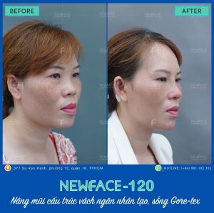 Hình ảnh nâng mũi trước sau Bs Trần Phương - Ca 120