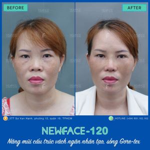 Hình ảnh nâng mũi trước sau Bs Trần Phương - Ca 120