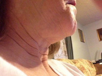 Kết quả ngoài mong đợi sau cắt mí, căng da mặt và căng da cổ ở tuổi 59