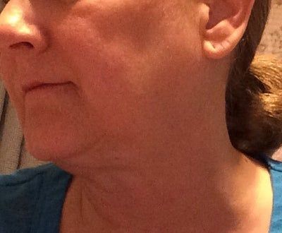 Kết quả ngoài mong đợi sau cắt mí, căng da mặt và căng da cổ ở tuổi 59
