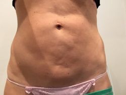 Tạo hình thành bụng mini có sửa được bụng lồi lõm do hút mỡ hỏng không?