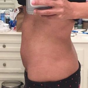 Cơ bụng phân tách thì nên tạo hình thành bụng mini hay tạo hình thành bụng toàn phần?