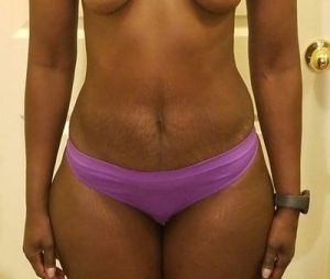 Có thể chỉnh sửa cơ bụng trong khi tạo hình thành bụng mini không?