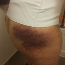 Bị bầm tím ở mông sau tạo hình thành bụng mini và hút mỡ có bình thường không?