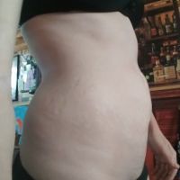 Tập thể dục có giảm được da chùng ở bụng không hay phải tạo hình thành bụng mini?