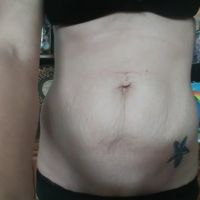 Tập thể dục có giảm được da chùng ở bụng không hay phải tạo hình thành bụng mini?