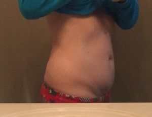 Tạo hình thành bụng mini kết hợp hút mỡ có hiệu quả hơn tạo hình thành bụng toàn phần không?