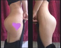 Hai bên mông đặt túi độn có hình dạng khác nhau