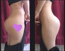 Hai bên mông đặt túi độn có hình dạng khác nhau