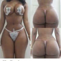 Kích cỡ và hình dạng túi độn như nào tốt nhất cho tôi?