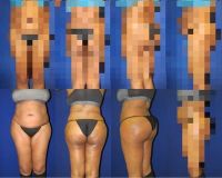 Kích cỡ và hình dạng túi độn như nào tốt nhất cho tôi?