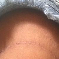 Đặt túi độn mông có thể làm cho phía sau của tôi nhô cao và nâng mông chảy xệ lên không?