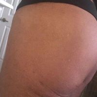 Đặt túi độn mông có thể làm cho phía sau của tôi nhô cao và nâng mông chảy xệ lên không?