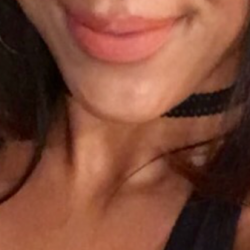 Radiesse có loại bỏ được rãnh mũi – má không?