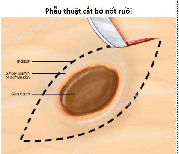 phau thuat cat bo