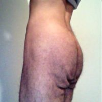 Nâng mông chảy xệ có giúp loại bỏ da lỏng lẻo sau giảm cân nhanh?