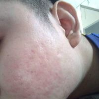 Laser v-beam trị ban đỏ sau mụn
