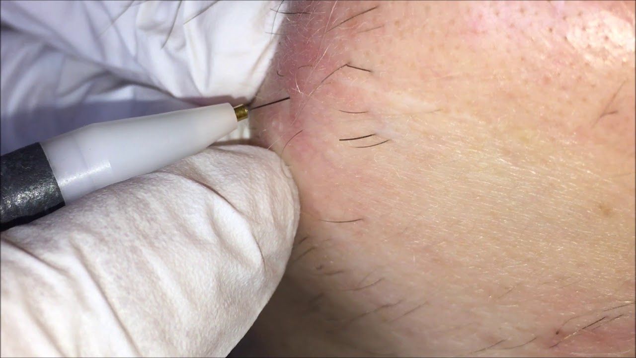 Triệt lông điện phân vùng cằm