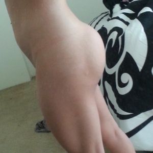 Túi độn mông ngày càng cứng và trông rất xấu