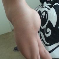 Túi độn mông ngày càng cứng và trông rất xấu