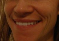 Restylane có trị được nếp nhăn hai bên miệng marionette line không?