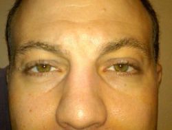 Nên tiêm filler hay cắt mí dưới để khắc phục rãnh nước mắt?