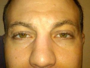 Nên tiêm filler hay cắt mí dưới để khắc phục rãnh nước mắt?