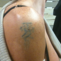 Laser PicoSure có phải là phương pháp xóa xăm nhanh không?