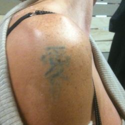 Laser PicoSure có phải là phương pháp xóa xăm nhanh không?