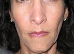 Có thể tiêm Radiesse để nâng gò má không?