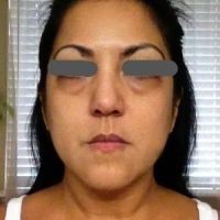 Restylane có trị được quầng thâm dưới mắt không? Restylane có trị được quầng thâm dưới mắt không?