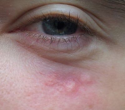 Biến chứng sau điều trị tĩnh mạch xanh quanh mắt bằng laser?