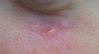 Biến chứng sau điều trị tĩnh mạch xanh quanh mắt bằng laser? Biến chứng sau điều trị tĩnh mạch xanh quanh mắt bằng laser?