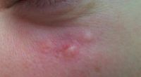 Biến chứng sau điều trị tĩnh mạch xanh quanh mắt bằng laser? Biến chứng sau điều trị tĩnh mạch xanh quanh mắt bằng laser?