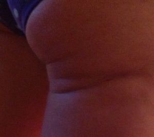 Có thể tiêm Radiesse vào đùi không?