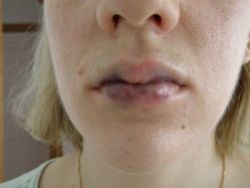 Làm thế nào để giảm sưng và bầm tím trên môi sau khi tiêm Restylane?