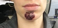 Như này có phải là bình thường sau khi điều trị bằng laser xung nhuộm màu không? Như này có phải là bình thường sau khi điều trị bằng laser xung nhuộm màu không?