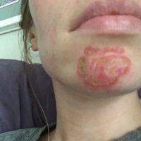 Như này có phải là bình thường sau khi điều trị bằng laser xung nhuộm màu không? Như này có phải là bình thường sau khi điều trị bằng laser xung nhuộm màu không?
