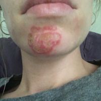 Như này có phải là bình thường sau khi điều trị bằng laser xung nhuộm màu không? Như này có phải là bình thường sau khi điều trị bằng laser xung nhuộm màu không?