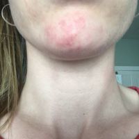 Như này có phải là bình thường sau khi điều trị bằng laser xung nhuộm màu không? Như này có phải là bình thường sau khi điều trị bằng laser xung nhuộm màu không?